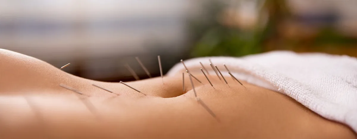 Acupuncture in IVF Treatment