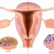  What Is OHSS (Ovarian Hyperstimulation Syndrome)? Risks and Safe IVF Treatment