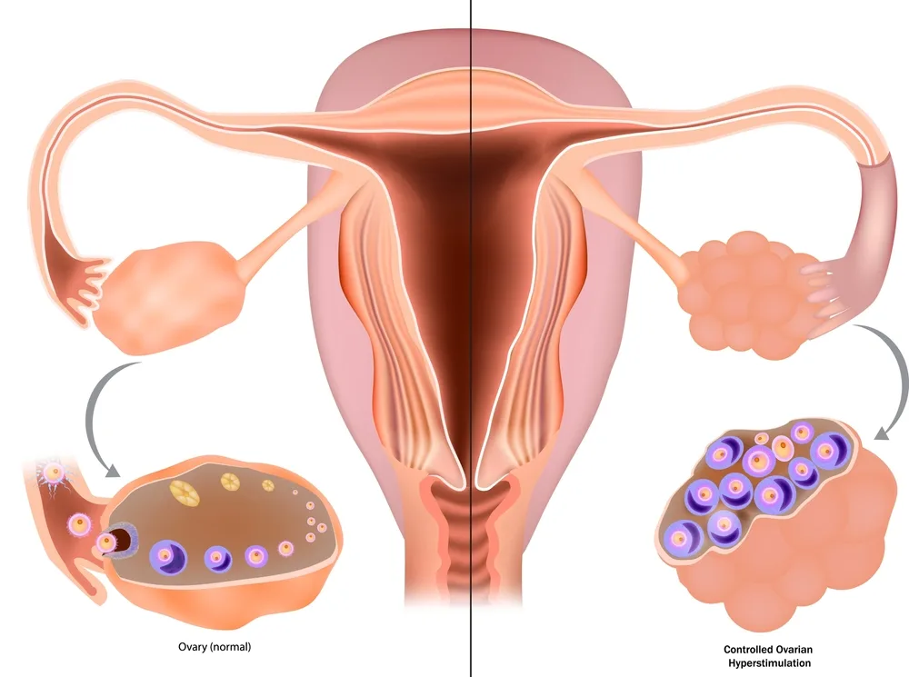 What Is OHSS (Ovarian Hyperstimulation Syndrome)? Risks and Safe IVF Treatment